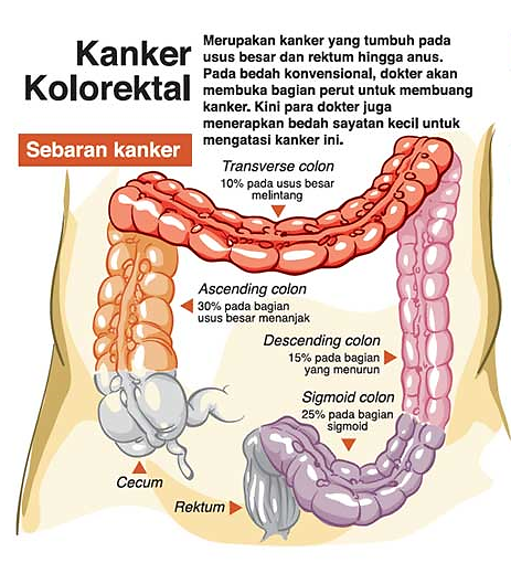 Mengungkap Penyebab Kanker Kolorektal