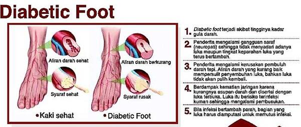 Pengelolaan DM dengan Melibatkan Keluarga Bisa Memperbaiki Kesehatan Diabetisi
