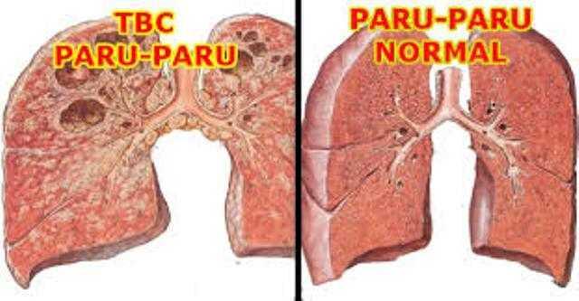 5 Penyakit Perenggut Nyawa Terbanyak