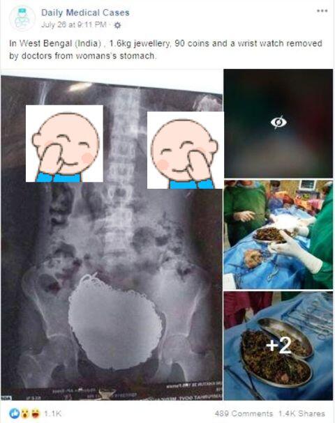 Wanita Ini Sengaja Menelan 1,6 Kilogram Perhiasan ke Dalam Perutnya! Ternyata Dia?