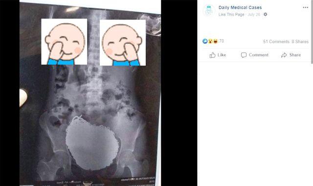 Wanita Ini Sengaja Menelan 1,6 Kilogram Perhiasan ke Dalam Perutnya! Ternyata Dia?