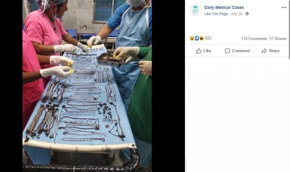 Wanita Ini Sengaja Menelan 1,6 Kilogram Perhiasan ke Dalam Perutnya! Ternyata Dia?