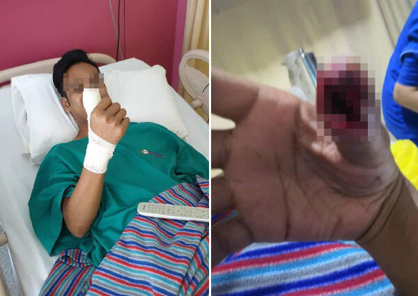 Awas! Gara-gara Screen Protector Pecah, Jempol Orang ini hampir di Amputasi