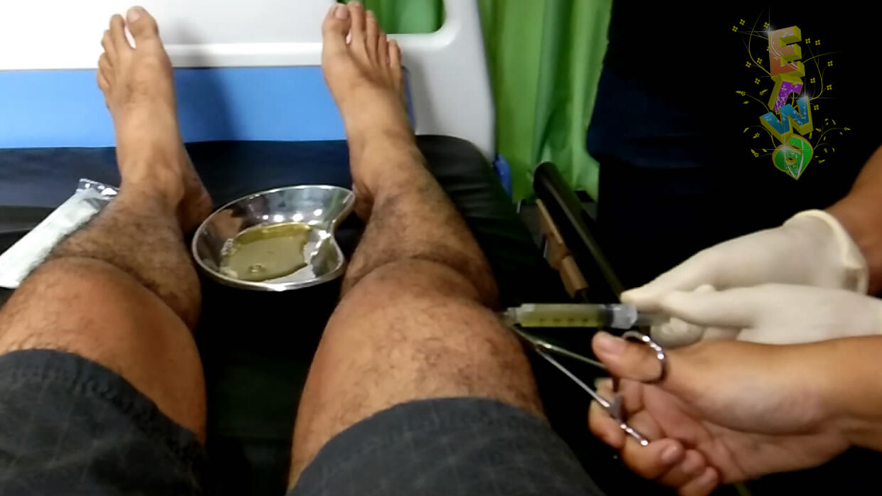 Sedot Cairan Di Sendi Lutut Karena Osteoarthritis