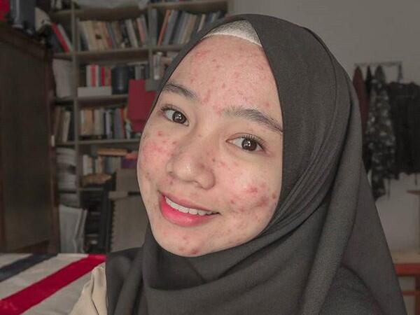 Salut! Walau Jerawatan Wanita Ini Tetap Pede Posting Foto Di Media Sosial.