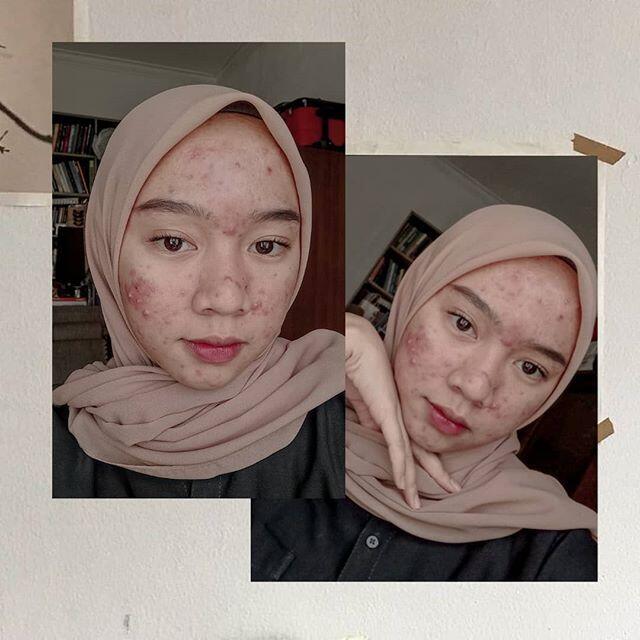 Salut! Walau Jerawatan Wanita Ini Tetap Pede Posting Foto Di Media Sosial.