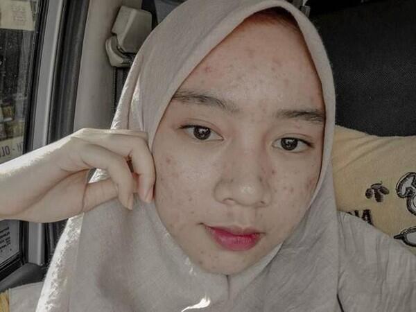 Salut! Walau Jerawatan Wanita Ini Tetap Pede Posting Foto Di Media Sosial.