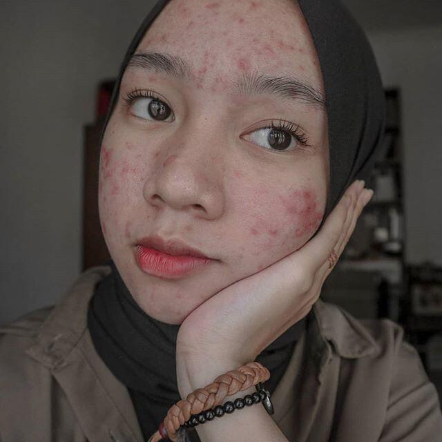 Salut! Walau Jerawatan Wanita Ini Tetap Pede Posting Foto Di Media Sosial.