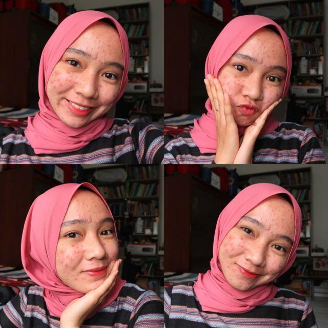 Salut! Walau Jerawatan Wanita Ini Tetap Pede Posting Foto Di Media Sosial.