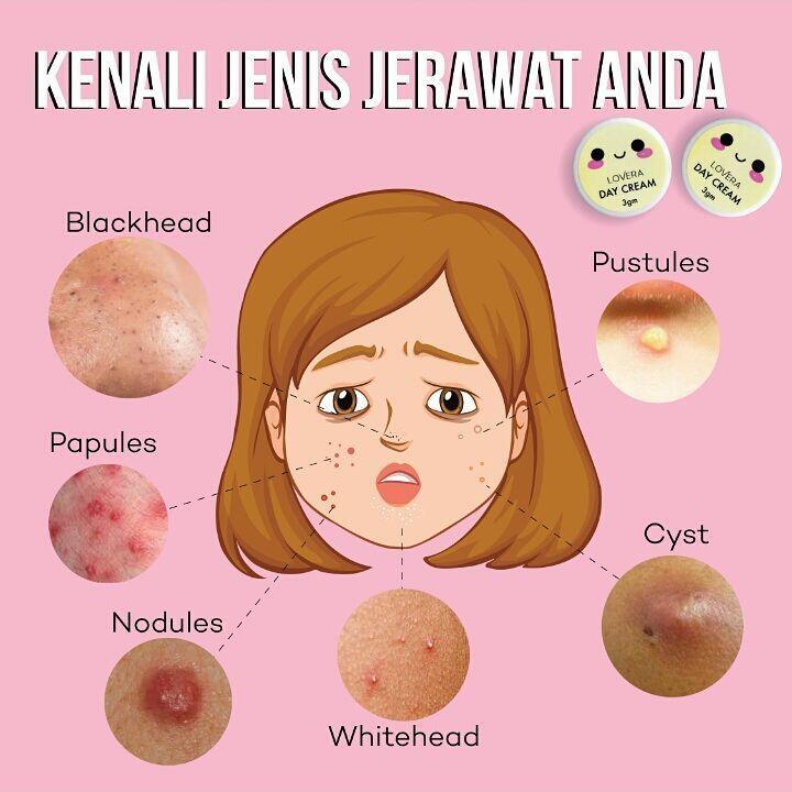 5 Hal ini Yang Ternyata Bisa Bikin Banyak Jerawat di Wajahmu