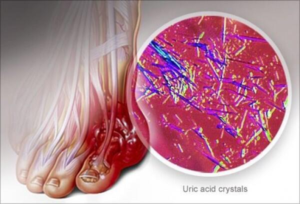 Penyakit Asam Urat, Fakta Medis dari Penyebab hingga Cara Mengobatinya