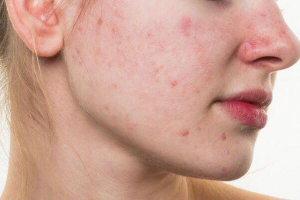 7 Penyebab Lain Kulit Alami Breakout Meski Rutin Pakai Skincare