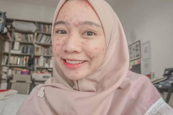 Tips Percaya Diri ala Novia Nur Ismi Selebgram 'Acne Fighter'