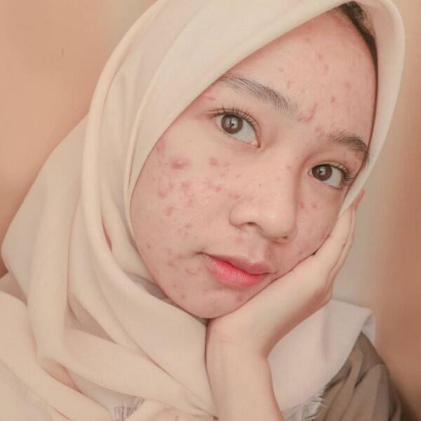 Tips Percaya Diri ala Novia Nur Ismi Selebgram 'Acne Fighter'