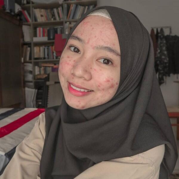 Tips Percaya Diri ala Novia Nur Ismi Selebgram 'Acne Fighter'