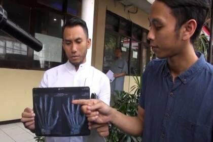 Sadis, 3 Jari Karyawan Kafe di Malang Remuk Dipalu Bos