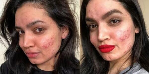 Ingat 5 Tips Penting Ini Sebelum Menutupi Jerawat dengan Makeup