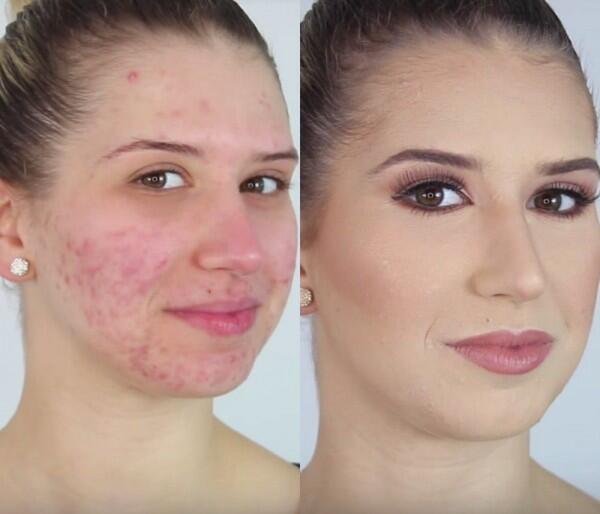 Ingat 5 Tips Penting Ini Sebelum Menutupi Jerawat dengan Makeup