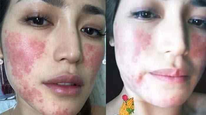 Ultherapy yang Bikin Wajah Jessica Iskandar Dipenuhi Bercak Merah