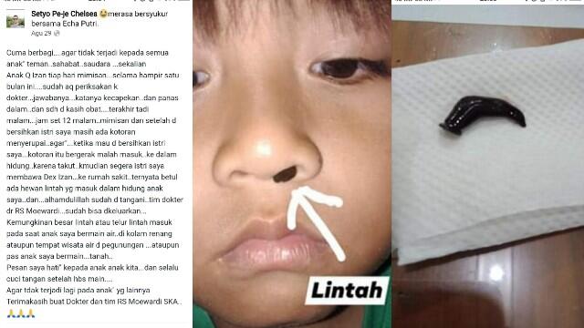 Hampir Sebulan Mimisan, Ternyata Ada Lintah di dalam Hidung Bocah Ini