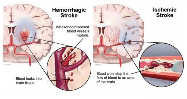 Terlalu Lama Main PUBG, Remaja 19 Tahun Kena STROKE