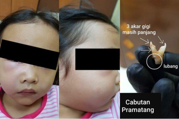 Nyawa Bocah Ini Hampir Melayang Gara-gara Giginya Berlubang