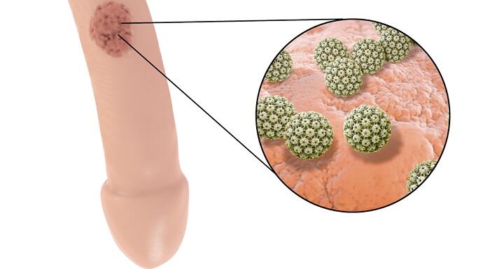 Inilah Penjelasan Seputar Kutil Kelamin