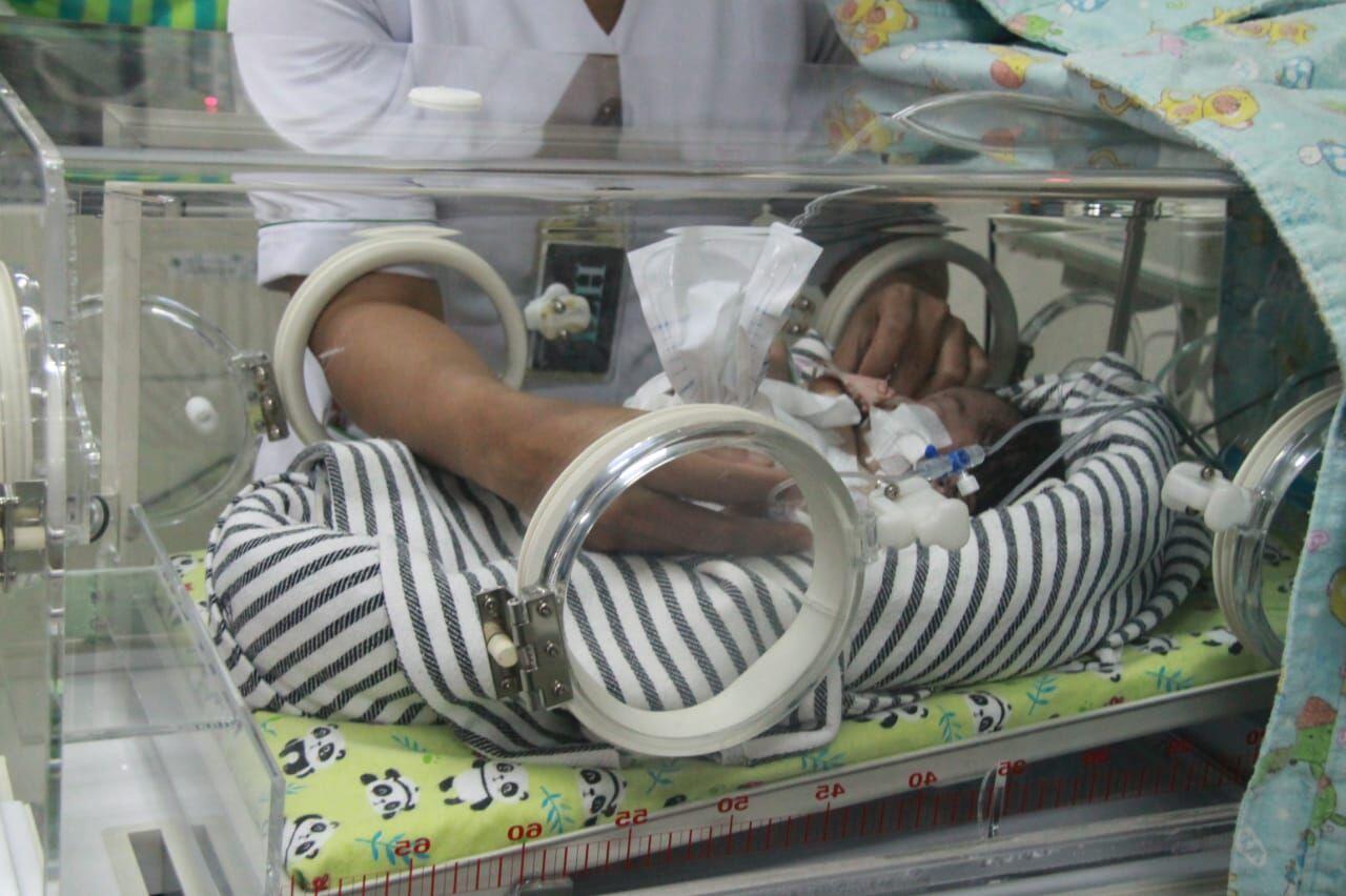Kondisi Menurun, Bayi Berkaki dan Bertangan Empat di Bali Meninggal