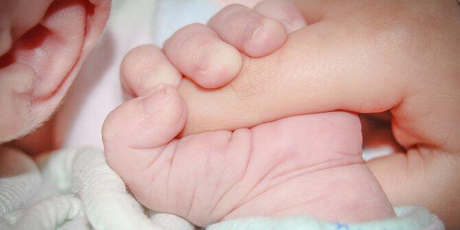 Kondisi Menurun, Bayi Berkaki dan Bertangan Empat di Bali Meninggal