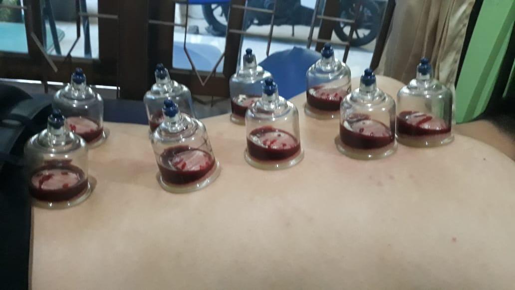 Pengalaman Bekam. Metode Pengobatan Sedot Darah Kotor