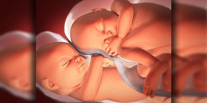 Waspada Mirror Syndrom dan TTTS, Moms! Penyebab Meninggalnya Bayi Kembar Irish Bella!