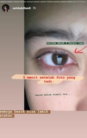 Wanita Ini Tidak Bisa Melihat Akibat Softlens. Sista Wajib Hati-Hati!