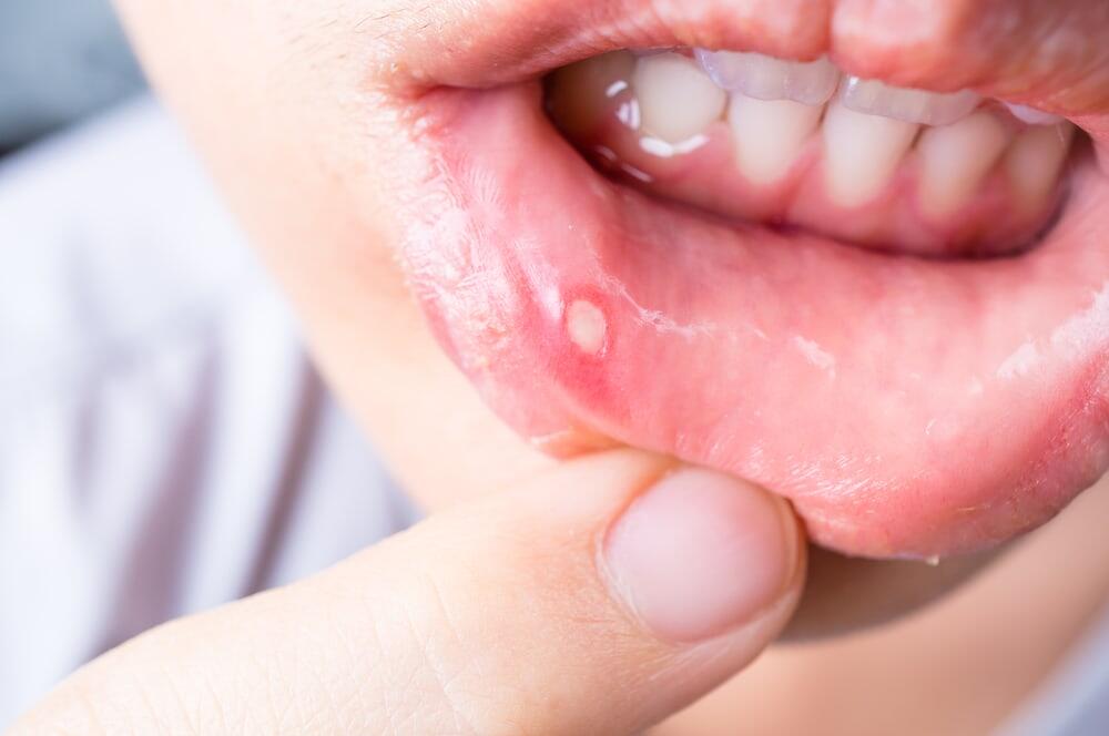 Tips Mengatasi Sariawan Dengan Bahan Alami