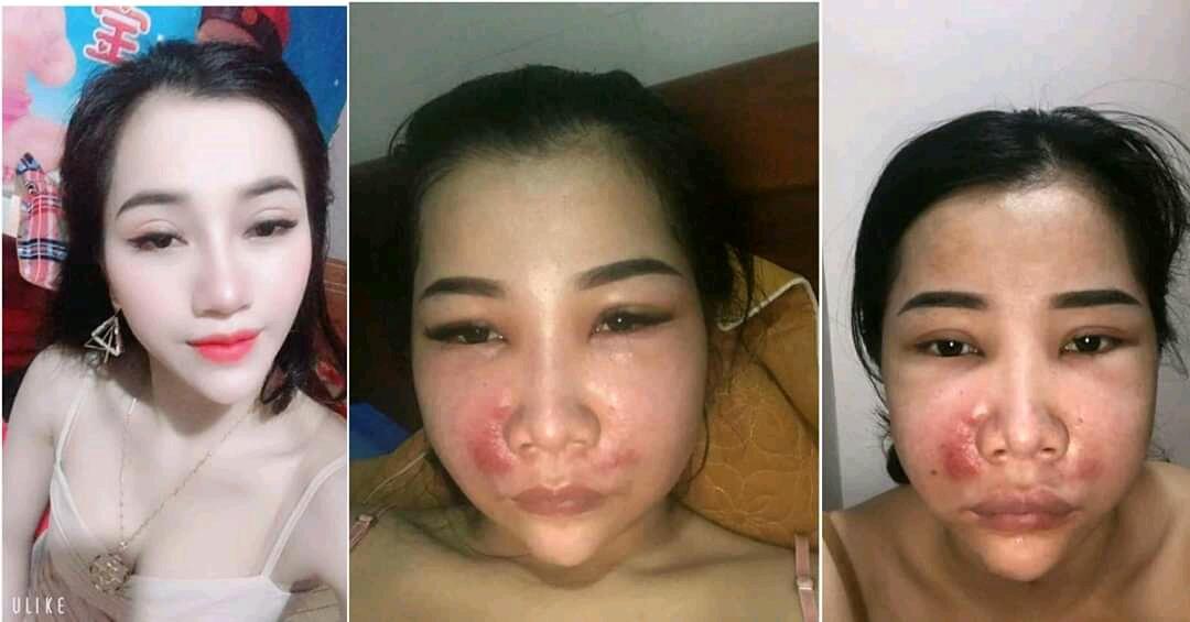 Mengerikan! Lihat Wajah Wanita Ini, Akibat dari Suntik Putih dan Tanam Benang