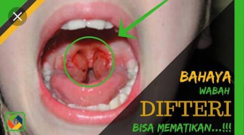 Waspada Difteri, Bisa Mematikan!