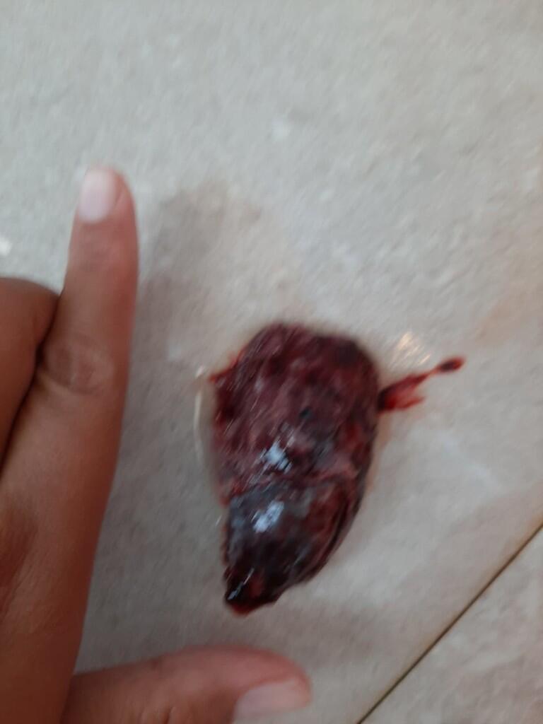 Hamil dan keguguran 9 minggu tanpa kuret