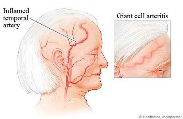 Kenali 7 Penyebab Sakit di Bagian Pelipis, dari Migrain hingga Tumor