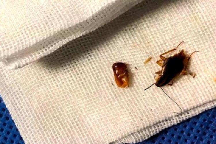 Keluarga Kecoak Ditemukan Dalam Telinga Seorang Pria di China