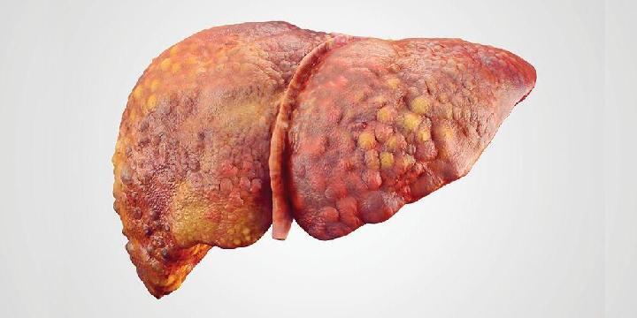 Hepatitis A, DPRD Kota Depok : Pemkot Tidak Becus