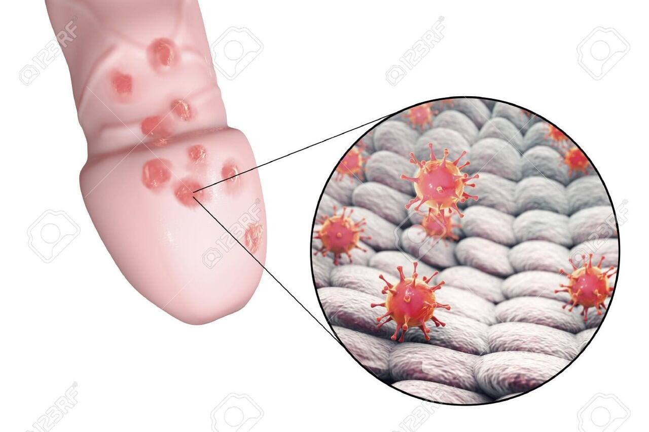 Hentikan Herpes Genital Menyebar dengan Terapi Gelombang Mikro