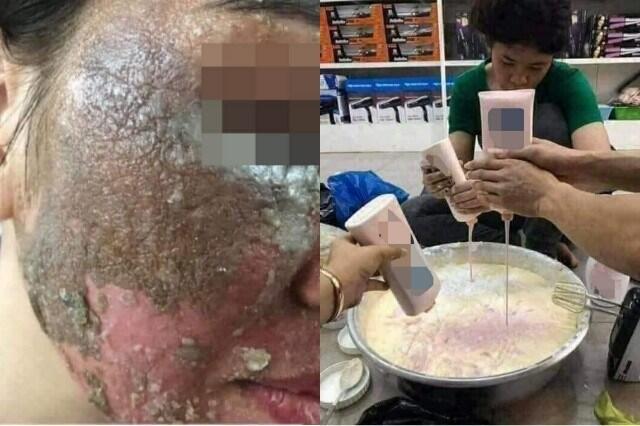 Hati-hati Gaes! Wajah Wanita Ini Hancur Gara-gara Pakai Skincare palsu
