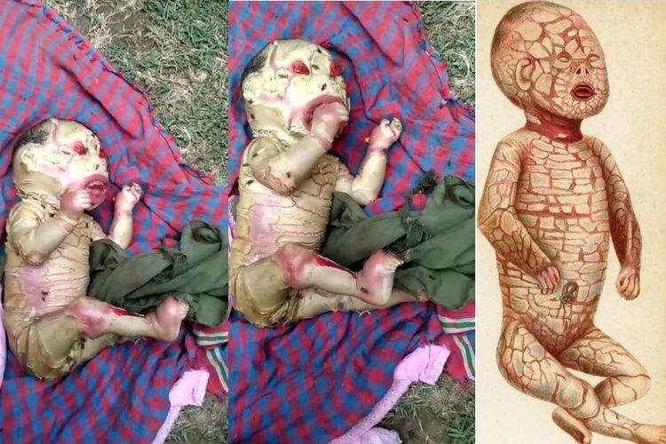 &#91;Hoaks&#93; Video Bayi Aneh di India, Nama Kondisinya Harlequin Ichthyosis