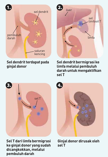 Proses Reaksi Penolakan Tubuh pada Cangkok Ginjal