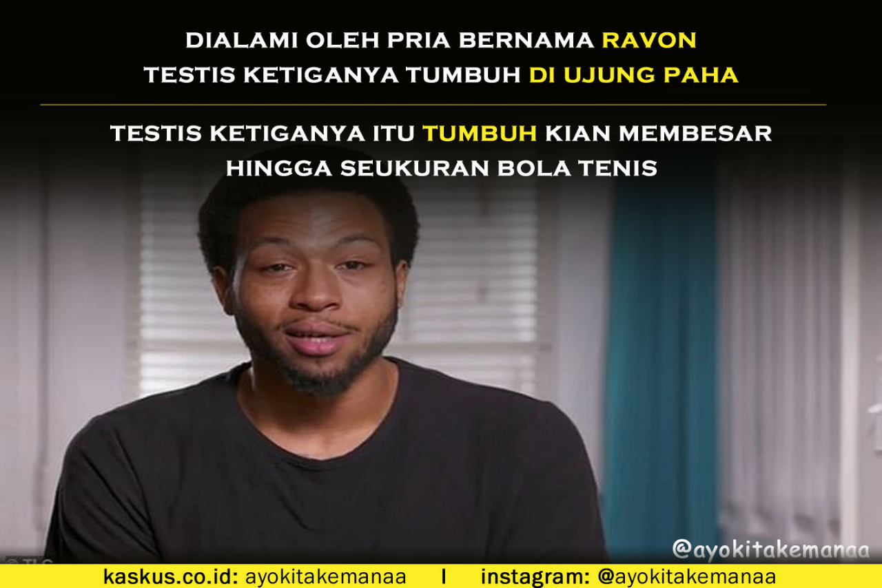 Merasa Tidak PD Saat Having Sex Dan Beraktivitas, Pria Ini Operasi Testis Ketiganya