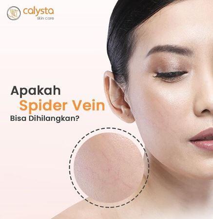 Apakah spider vein bisa dihilangkan