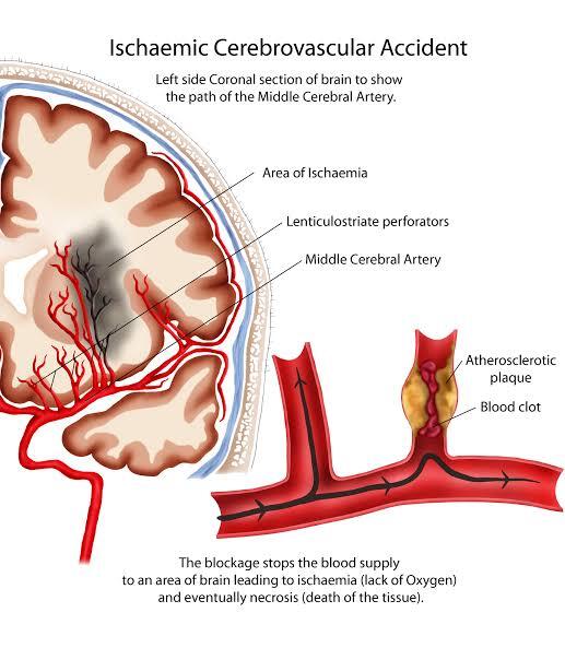 Mari Mengenal De Clérambault’s Syndrome Melalui Kisah Nyata Ini