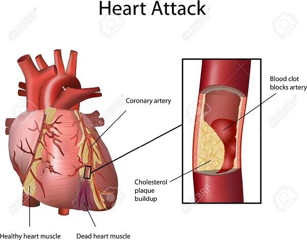 Pahami Sudden Cardiac Arrest, Penyebab Kematian Ashraf Sinclair, Suami BCL.