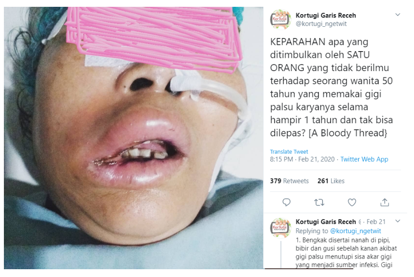 Gegara Tukang Gigi Abal-abal, Alami Infeksi hingga Ditangani 4 Dokter Spesialis
