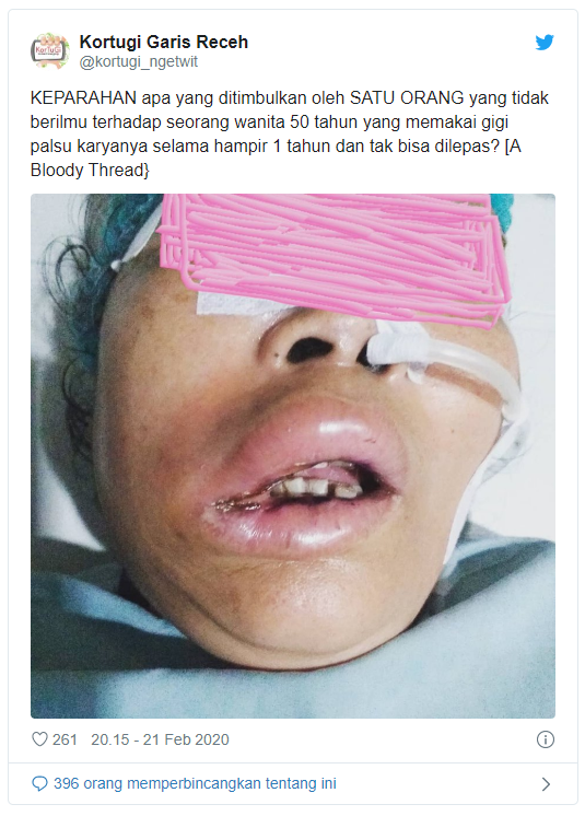 Gegara Tukang Gigi Abal-abal, Alami Infeksi hingga Ditangani 4 Dokter Spesialis