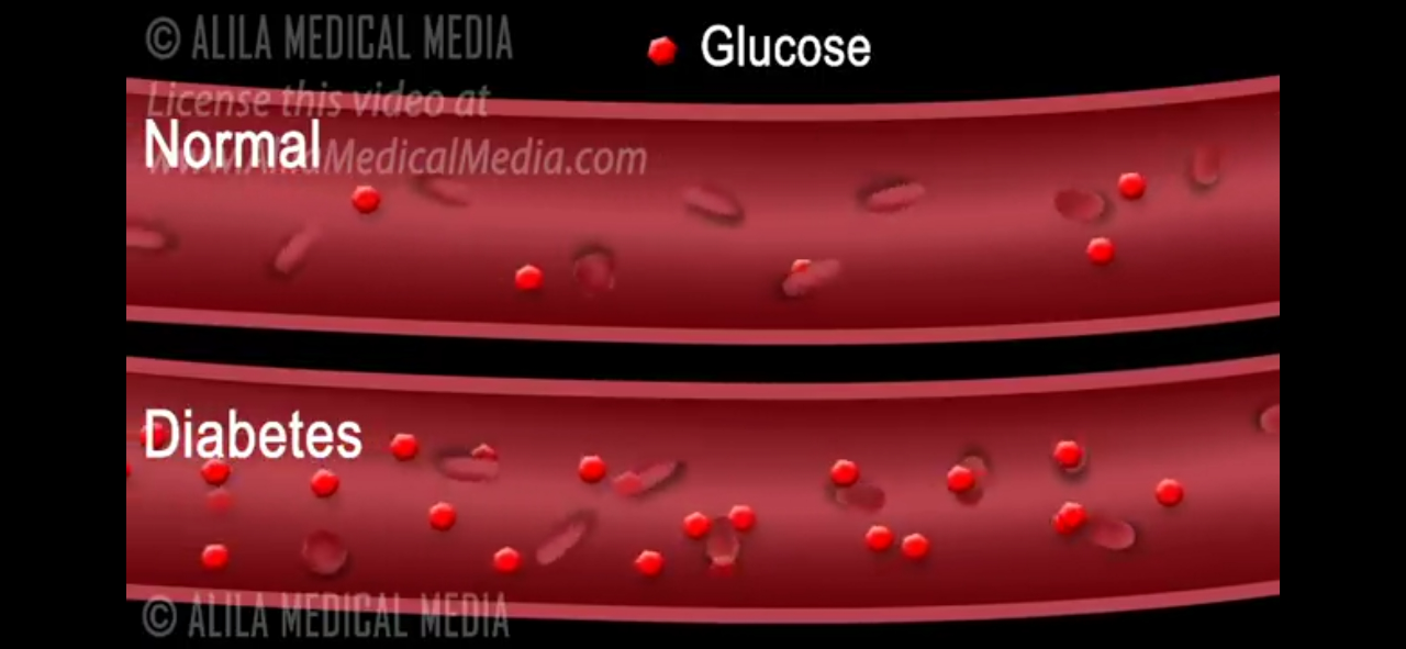 Apakah Diabetes Basah Dan Kering itu Ada??